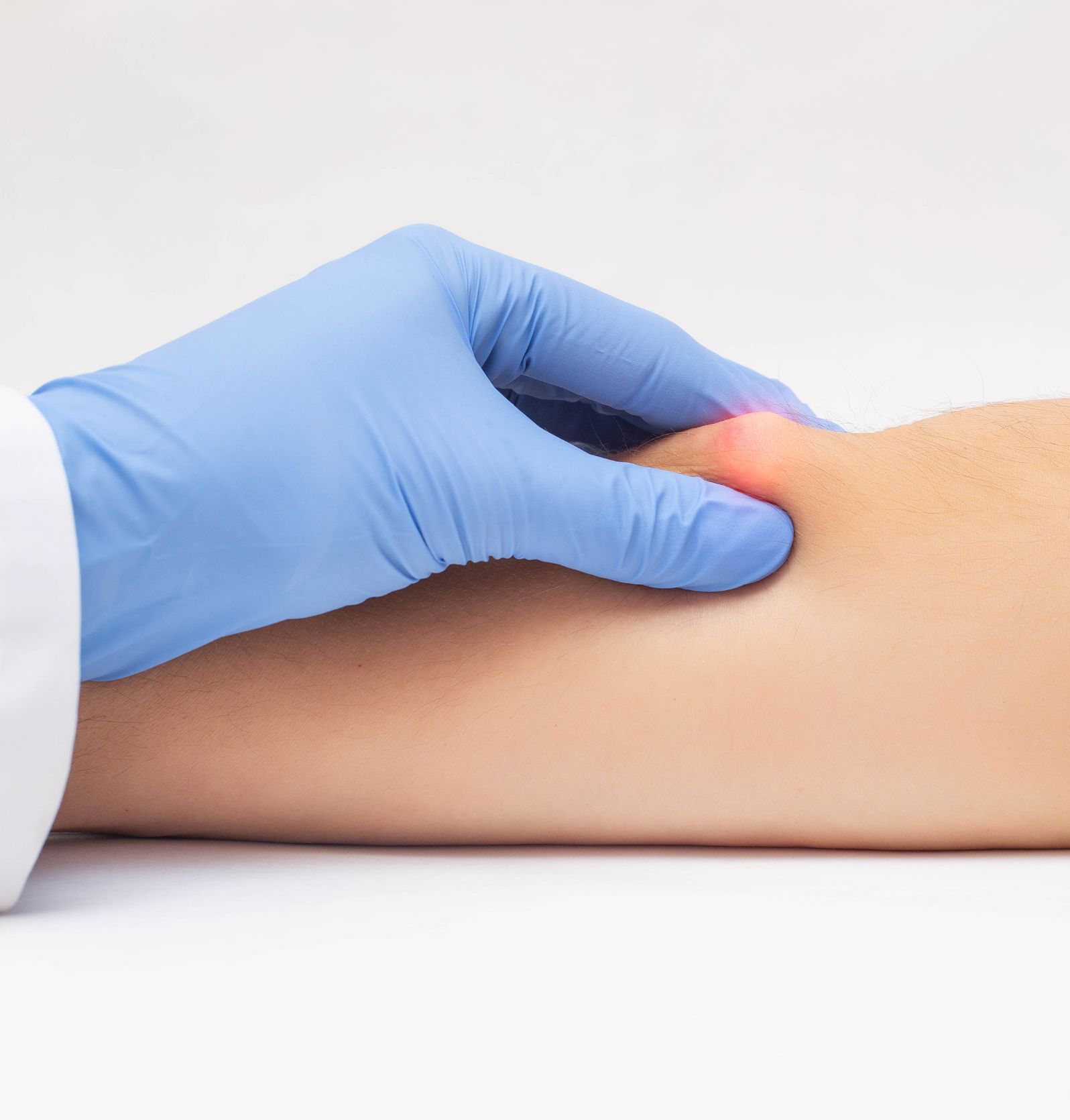Proctology | Padecimiento | Lipoma
